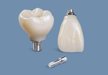 Implants Service Image